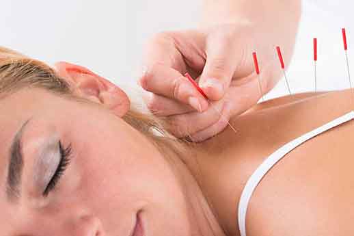 acupuncture