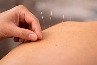 Acupuncture needle placement