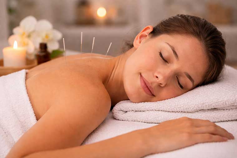 acupuncture for stress relief