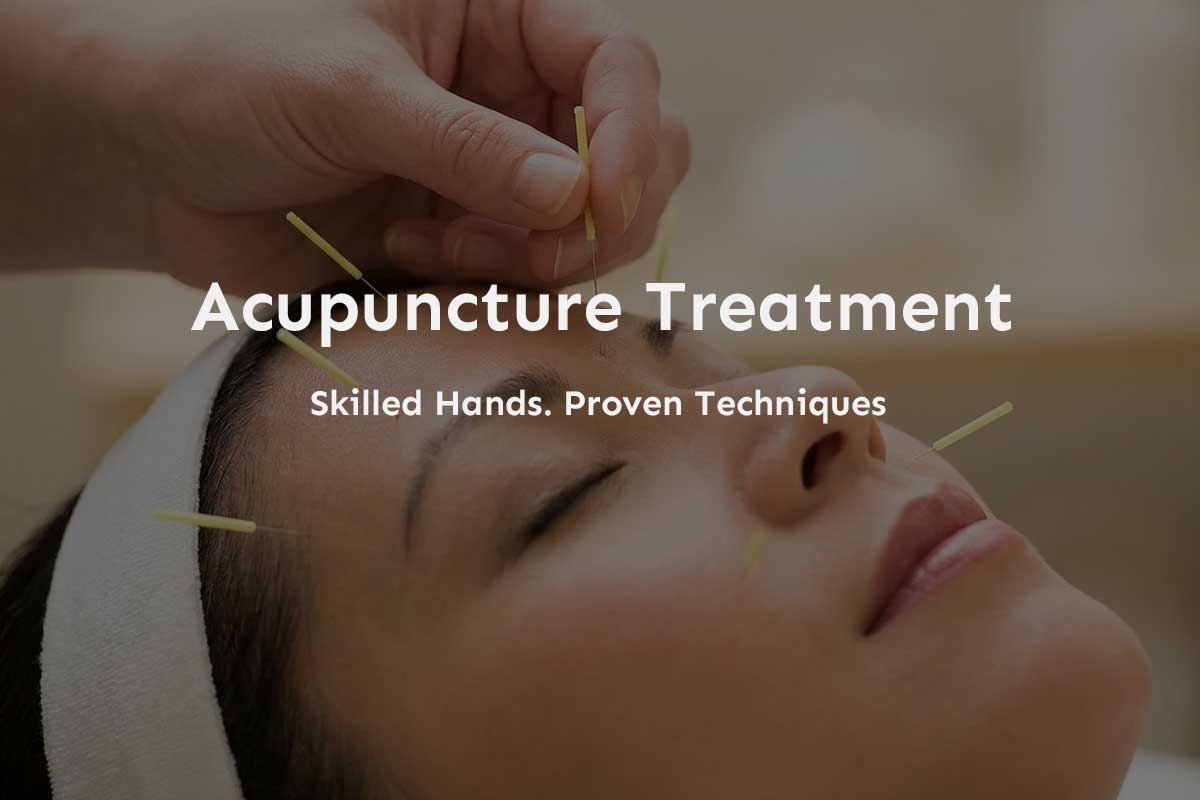 Acupuncture in Eugene Oregon