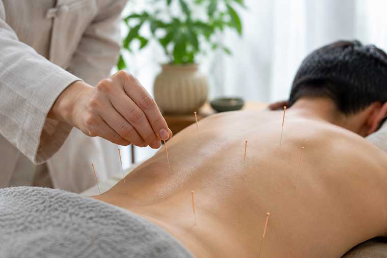 acupuncture for low back pain